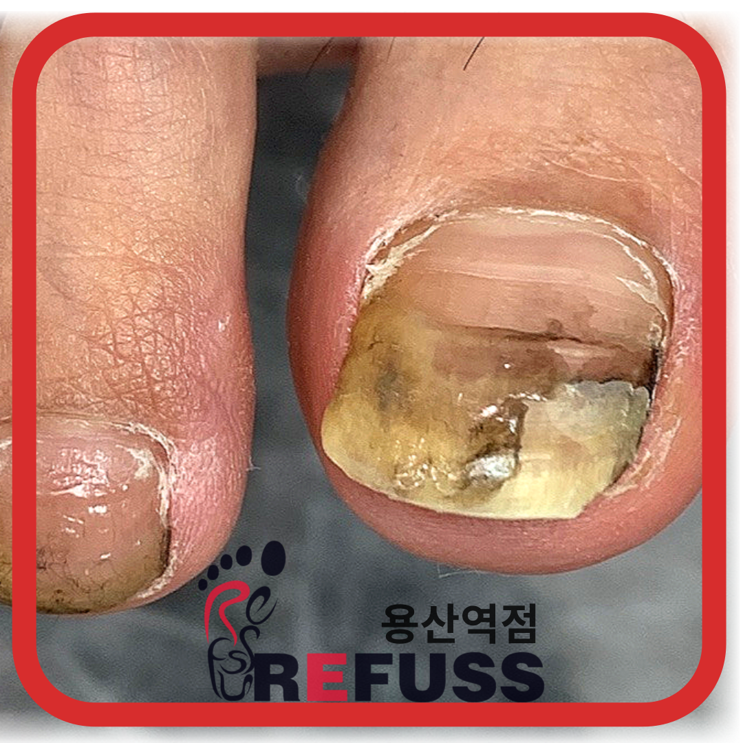 레푸스 용산역점 내성발톱 무좀발톱 발각질 문제성발
