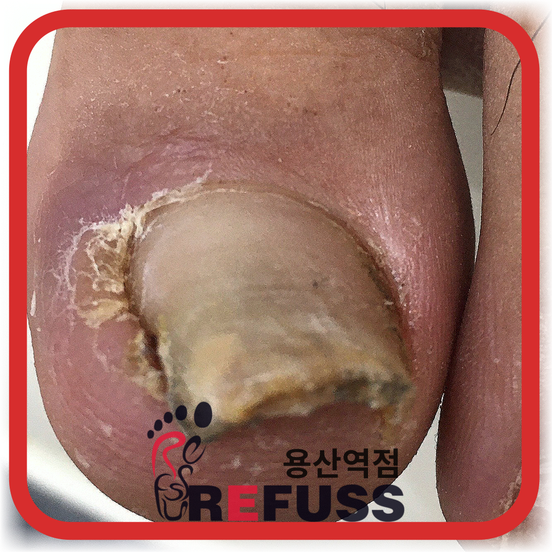 레푸스 용산역점 내성발톱 무좀발톱 발각질 문제성발