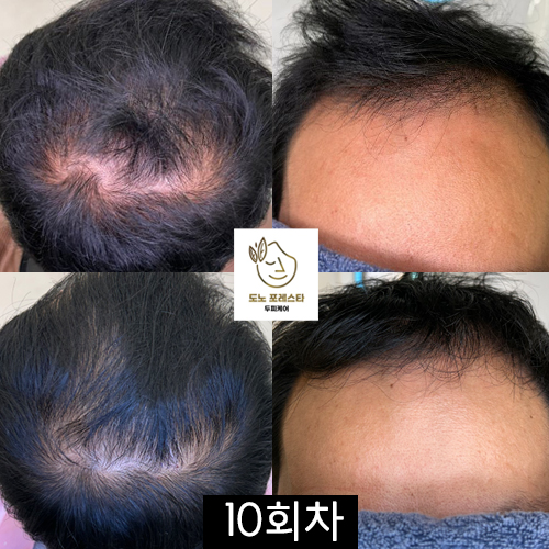 도노포레스타두피케어 대표 이미지