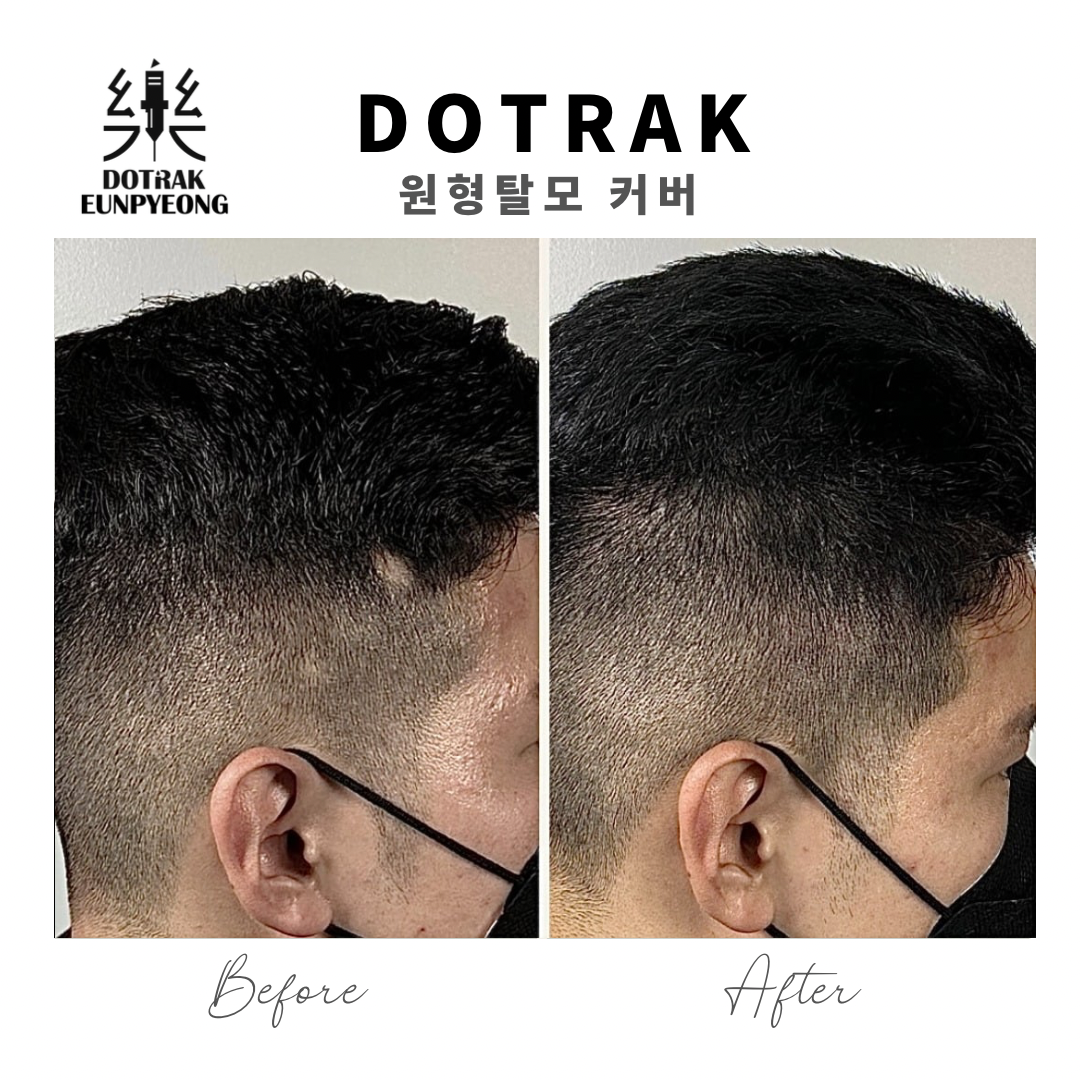 도트락 은평점 시술 이미지