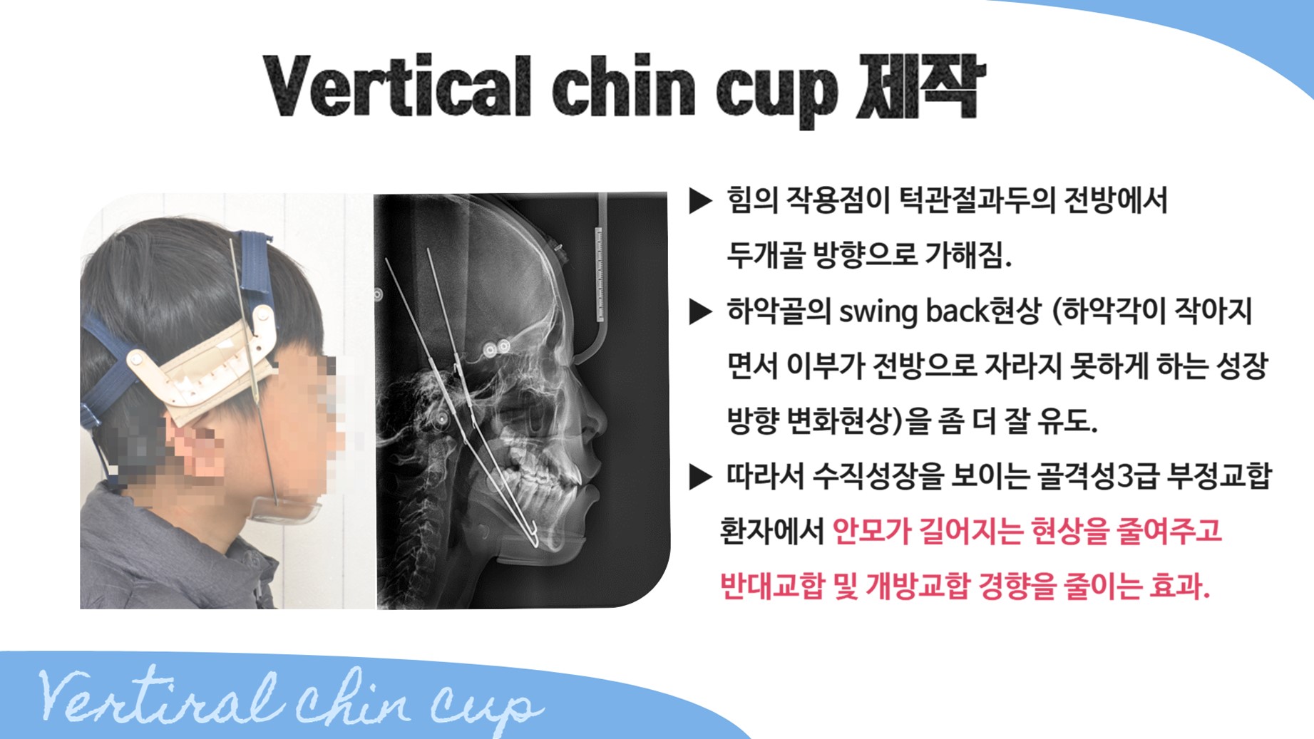 교정 장치 제작 이미지