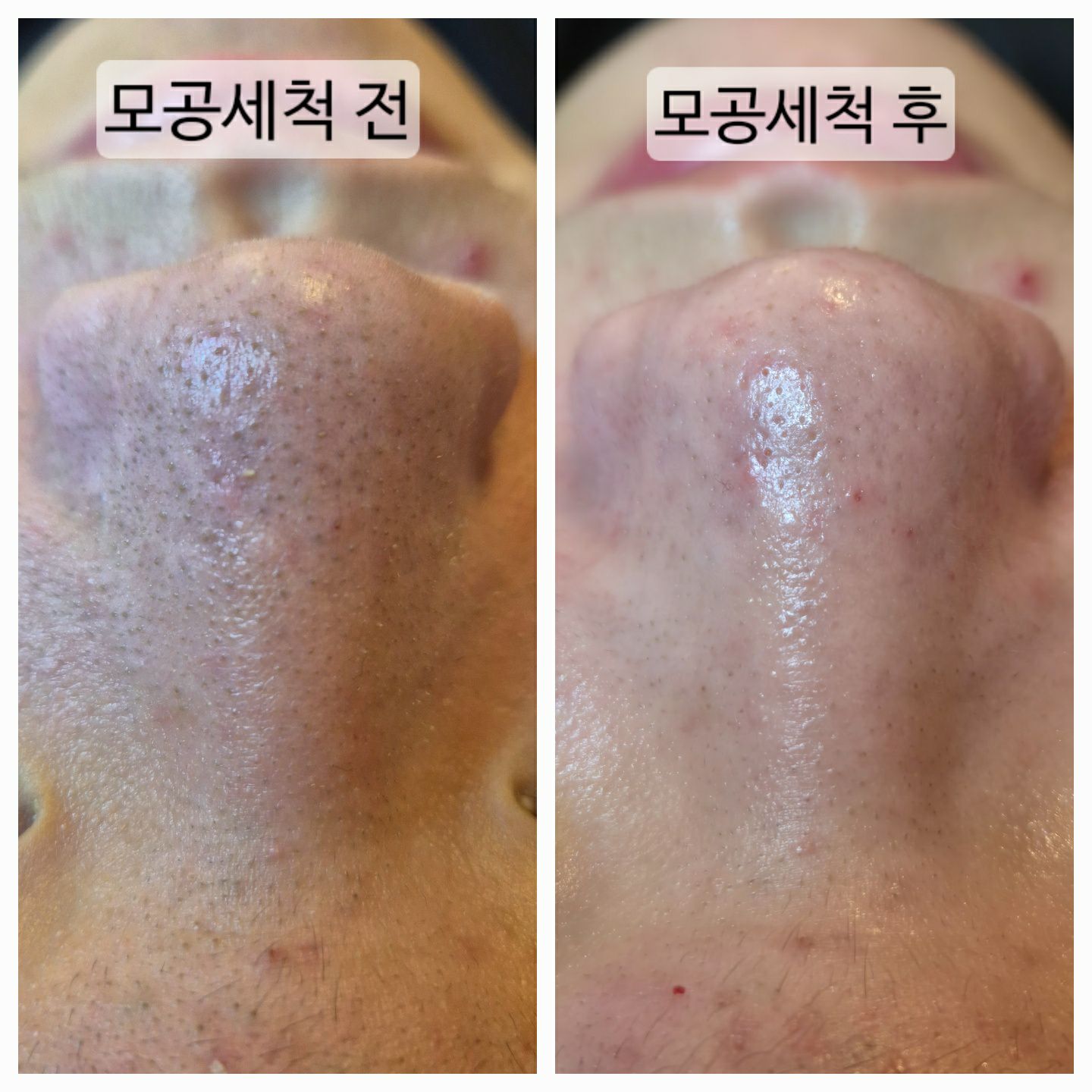 고원장의모공세척 대표 이미지