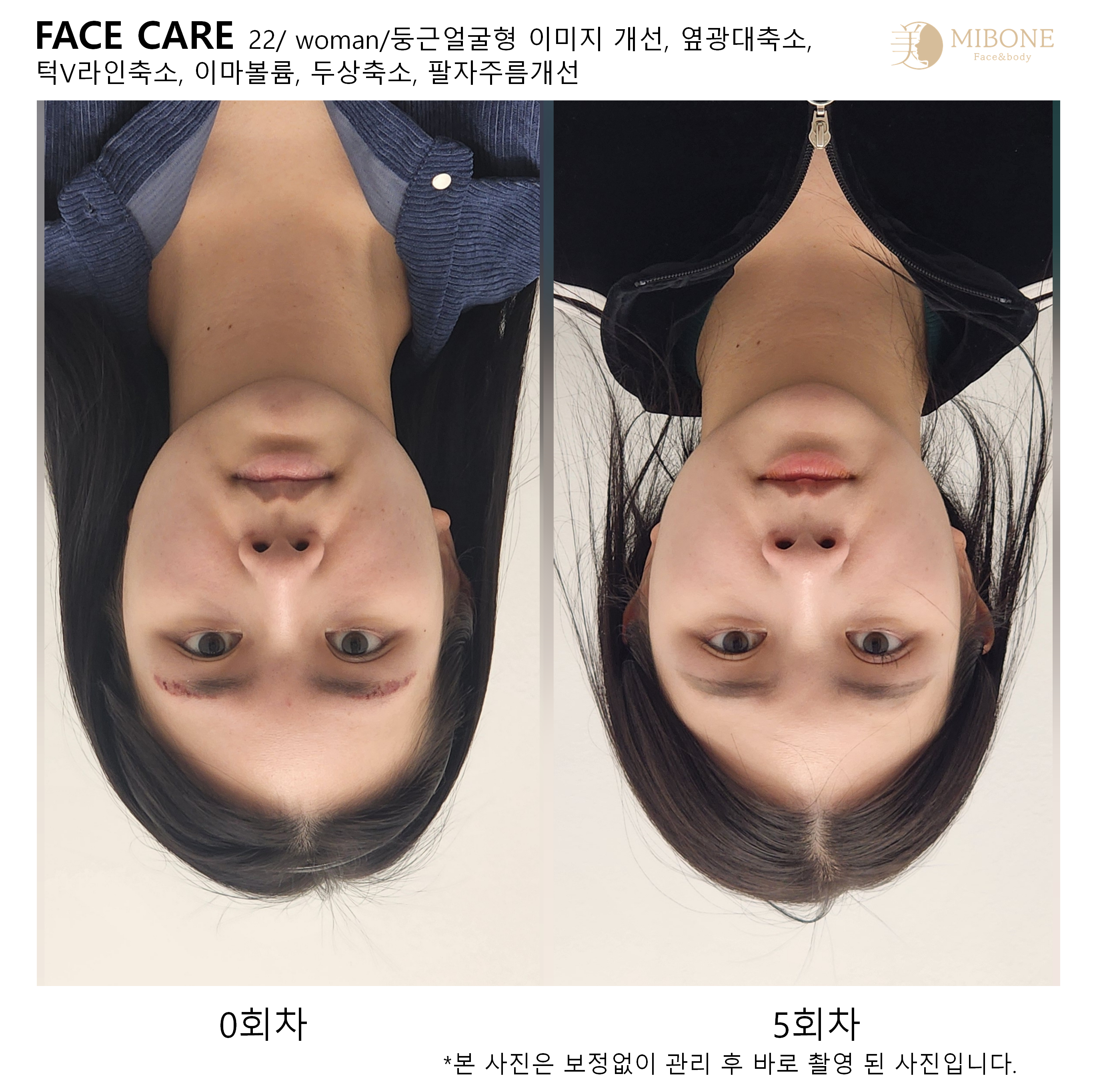 미본 얼굴윤곽관리 강남점 photo 10