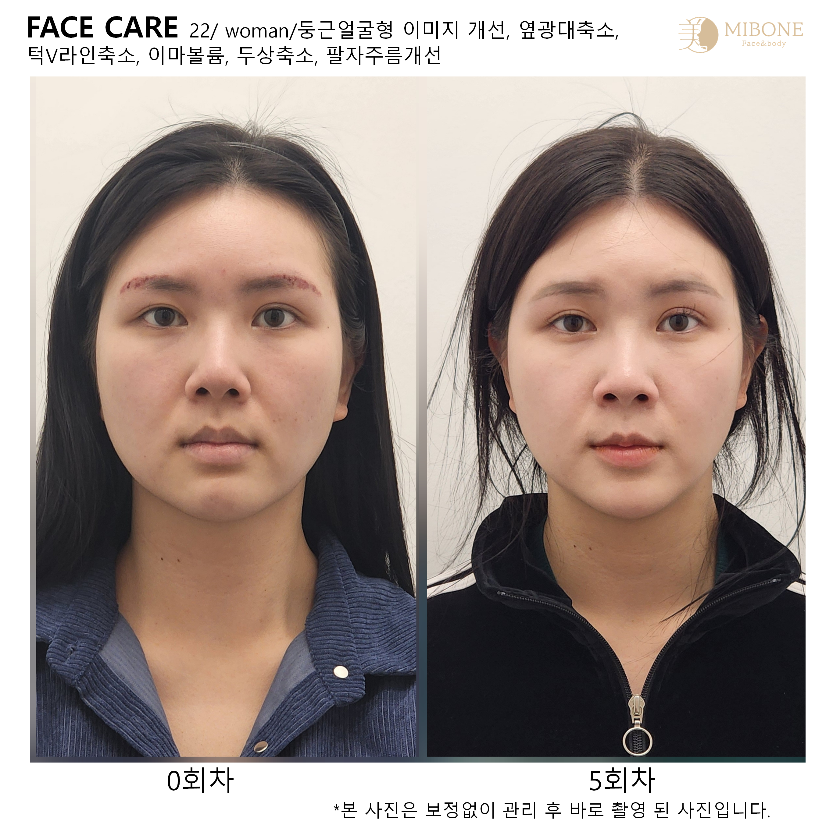 미본 얼굴윤곽관리 강남점 photo 9