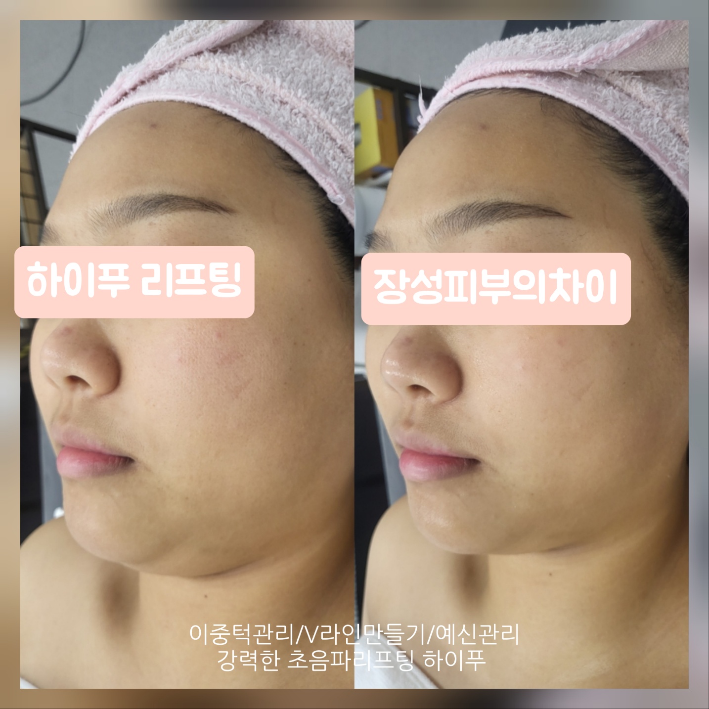 피부의차이 photo 5