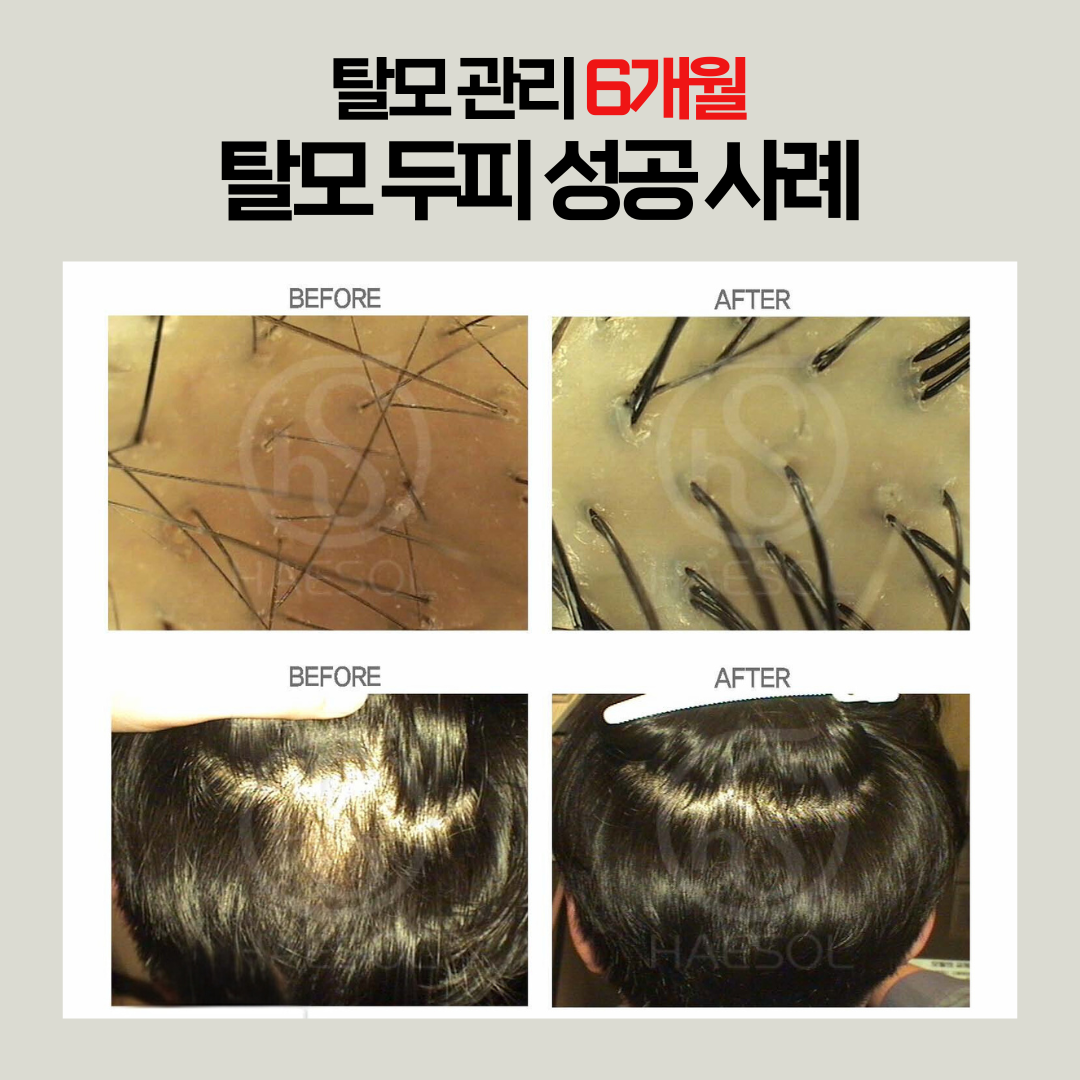 헤솔 두피클리닉스 롯데부산광복점