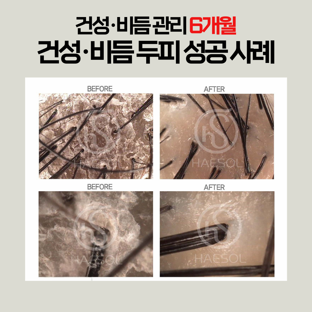 헤솔 두피클리닉스 롯데부산광복점