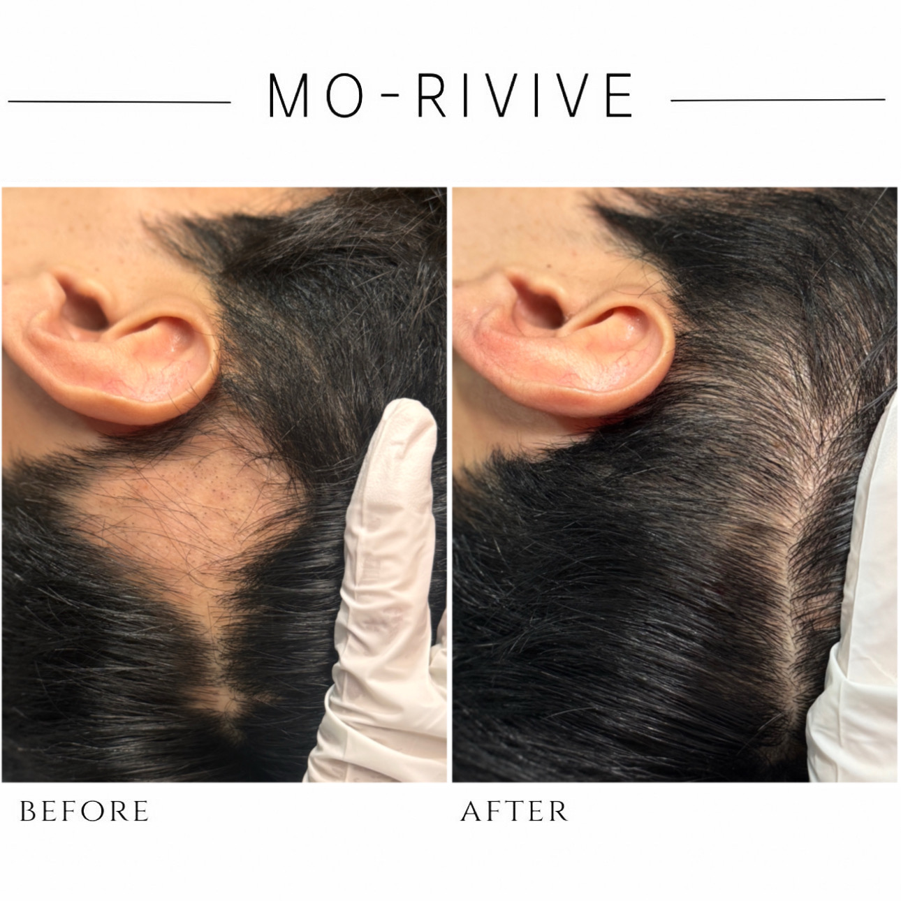 도라랩 두피탈모 모리바이브 대표 이미지