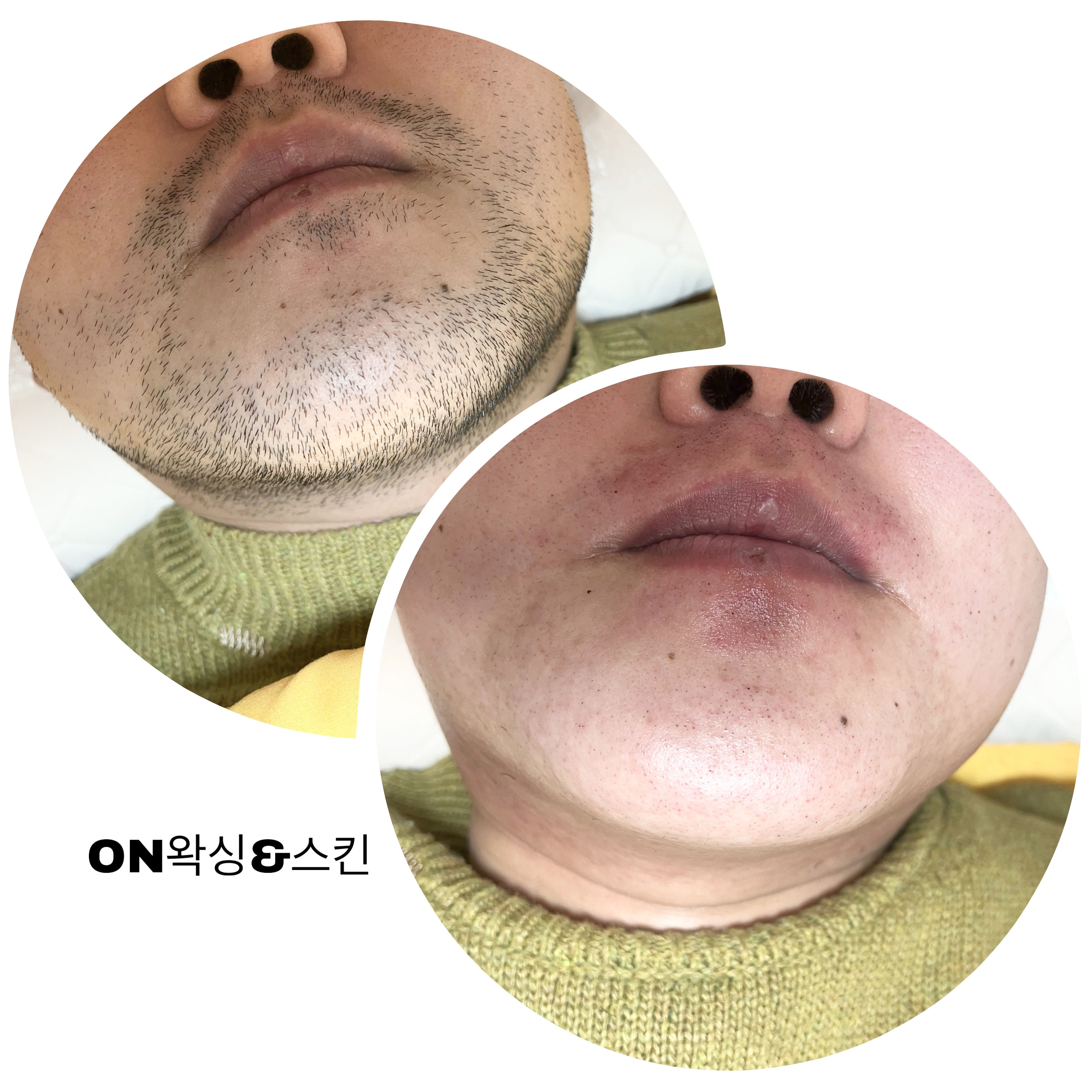 온왁싱&스킨
