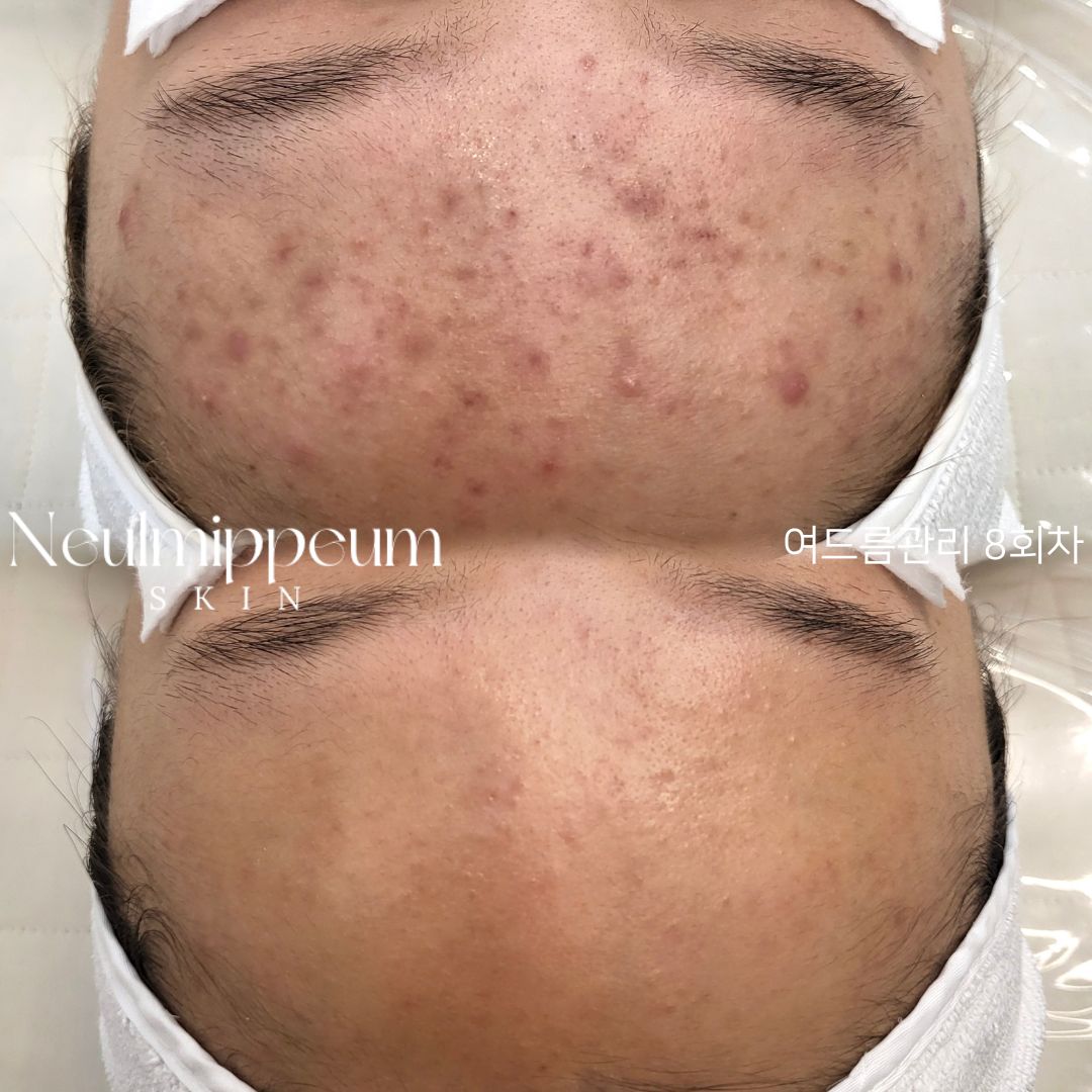 늘미쁨스킨 평택고덕본점 대표 이미지 - 여드름 관리