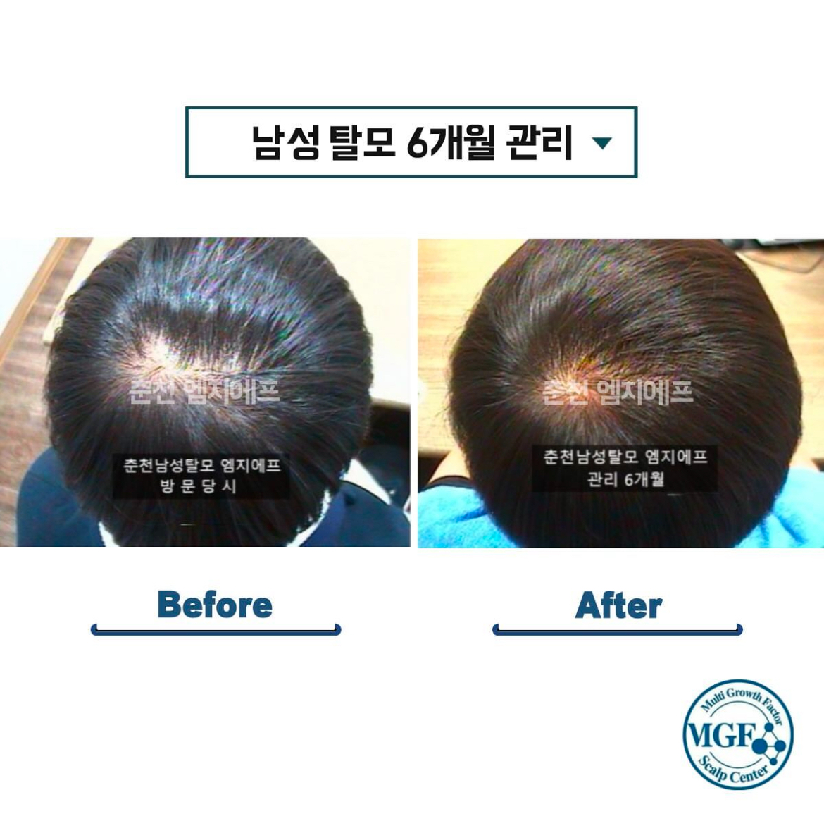 엠지에프 두피탈모 전문센터 춘천점 대표 이미지