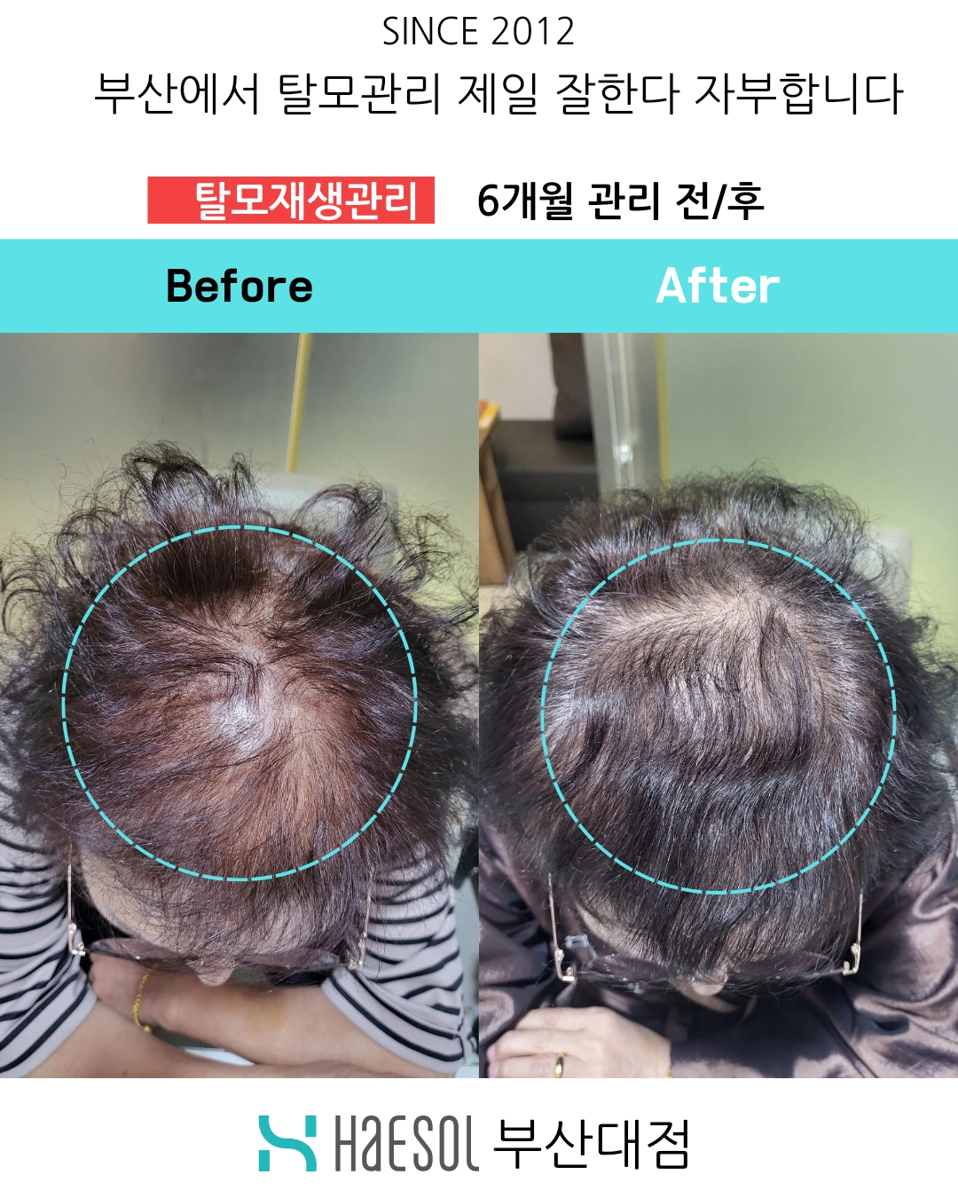 헤솔두피클리닉스 부산대점