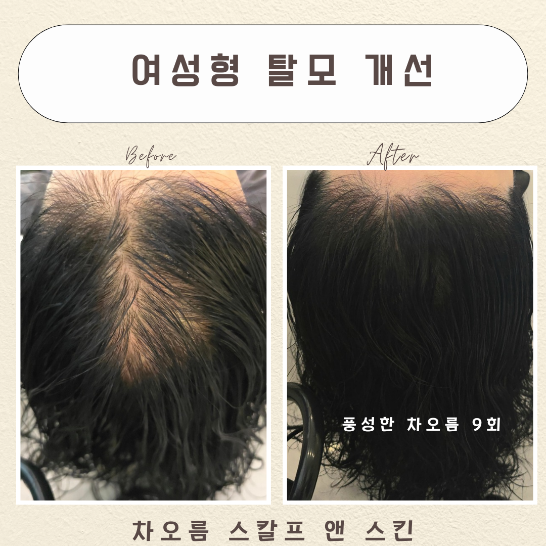 차오름 스칼프