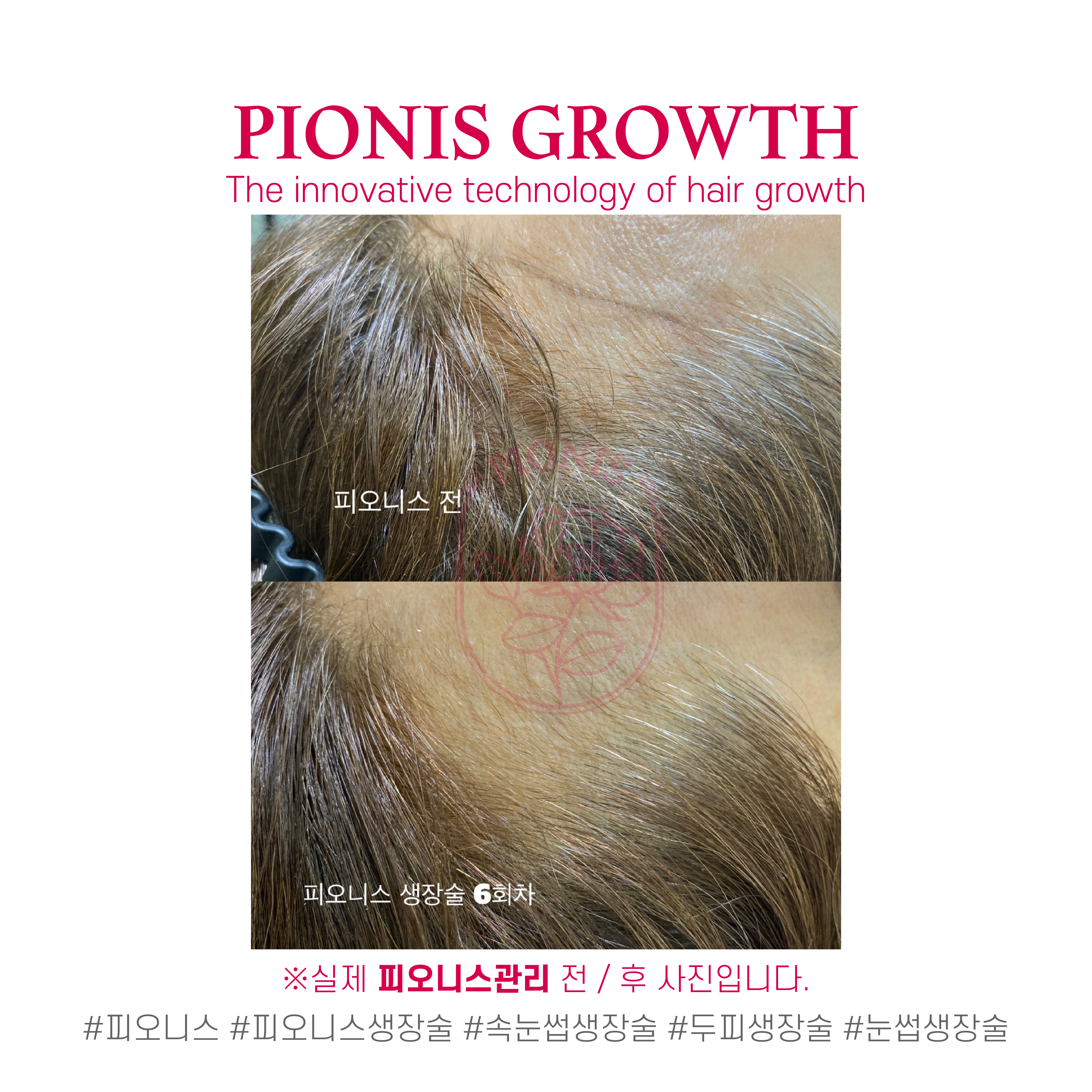 퀸즈스칼프