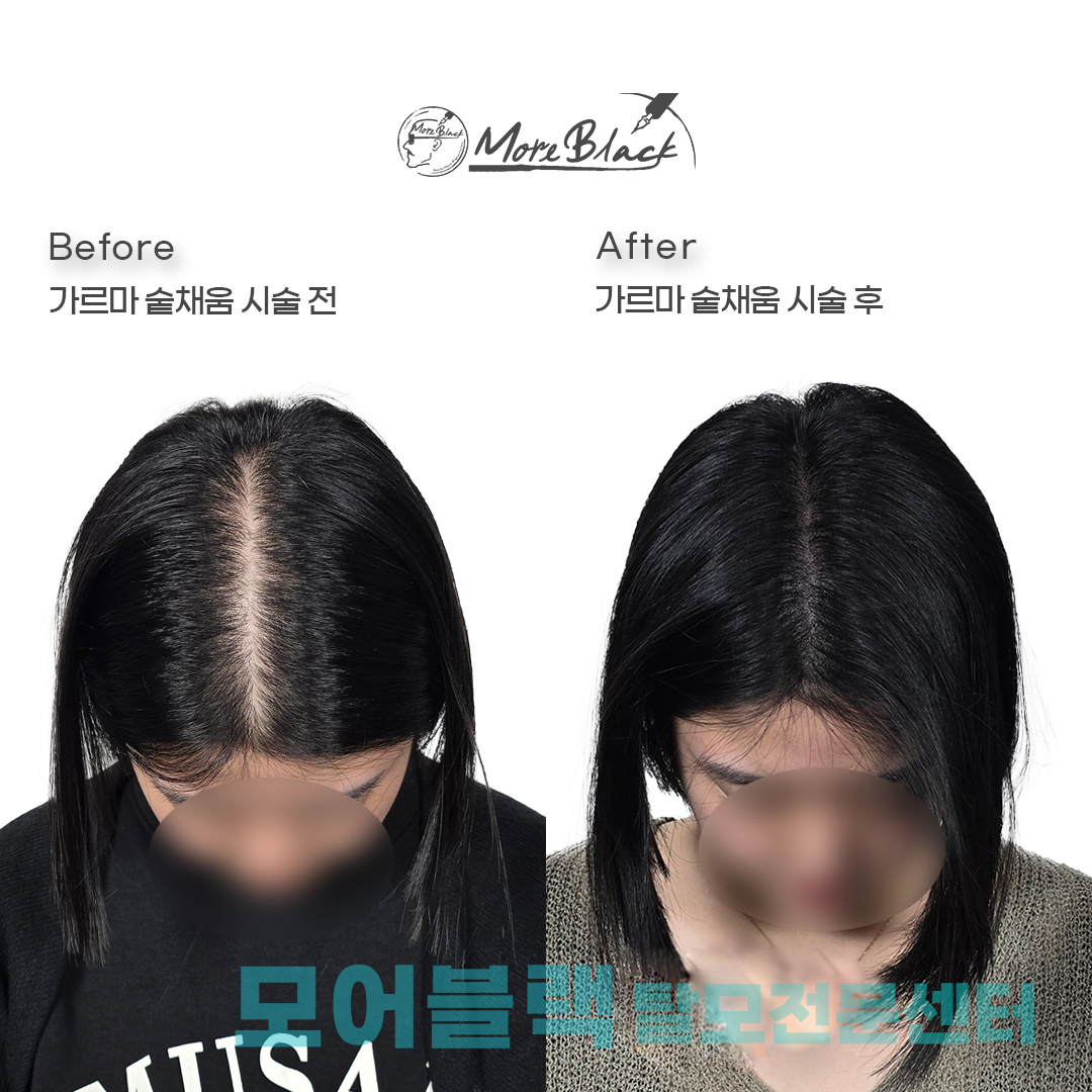 모어블랙 두피 탈모 전문센터 대전본점 대표 이미지