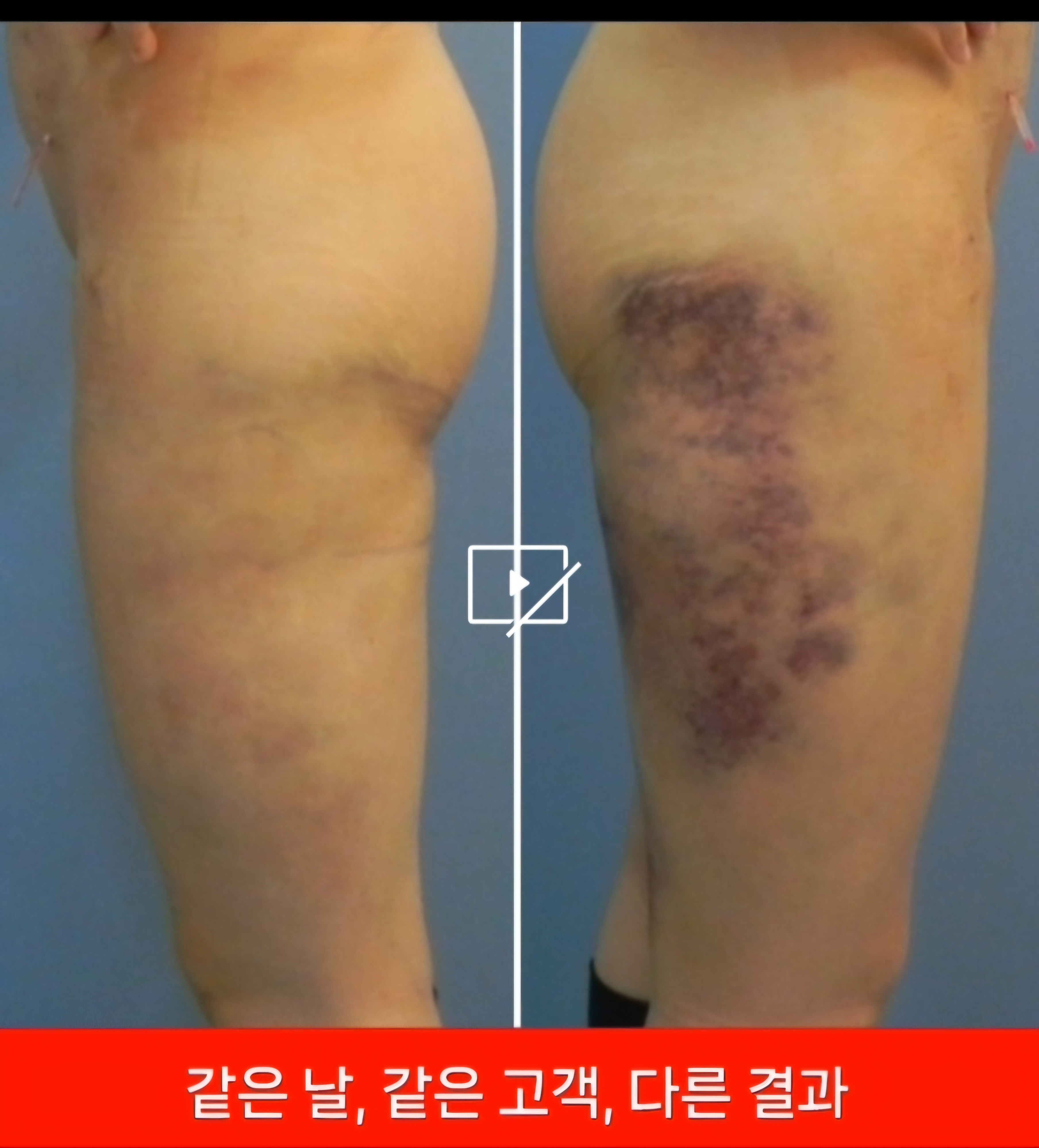 비타C스킨갤러리