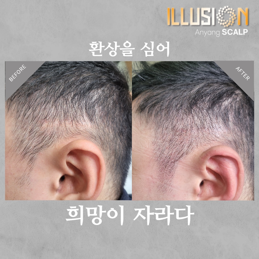 일루젼스칼프 안양