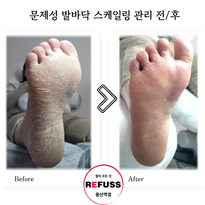 레푸스 용산역점 내성발톱 무좀발톱 발각질 문제성발