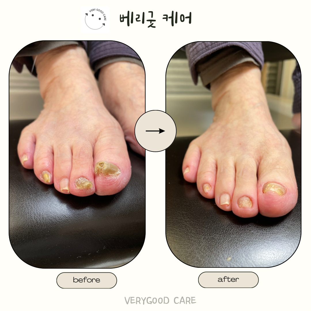 베리굿케어울산내성발톱무좀