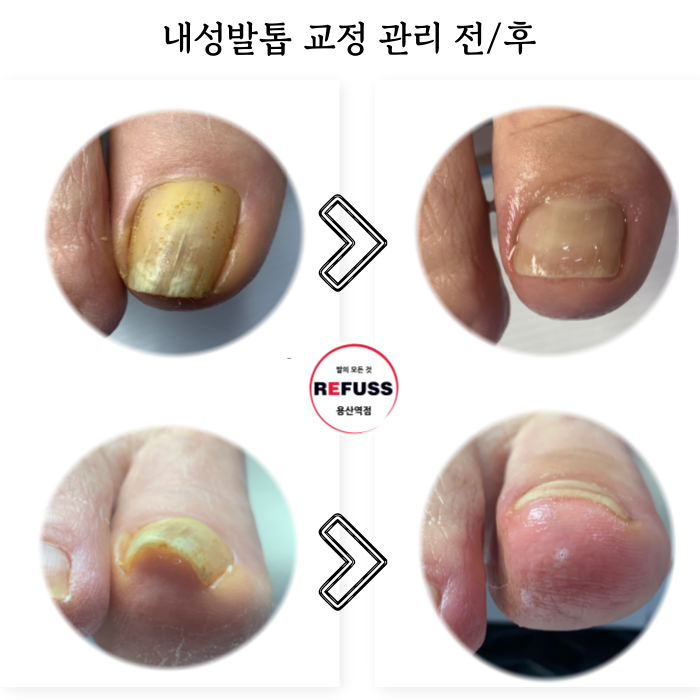 레푸스 용산역점 내성발톱 무좀발톱 발각질 문제성발