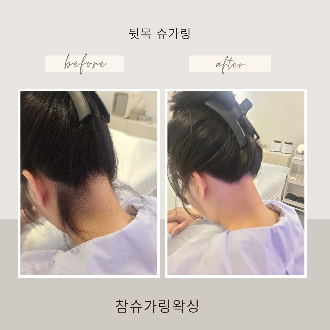 참슈가링왁싱