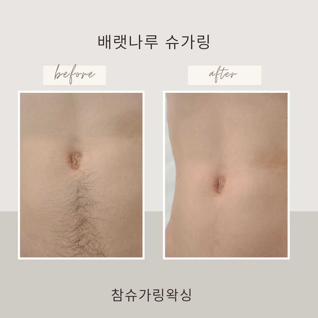참슈가링왁싱
