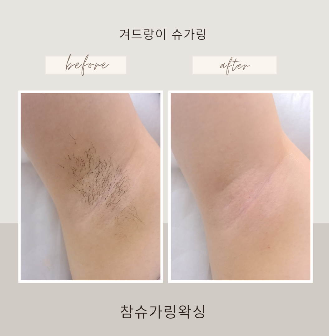 참슈가링왁싱