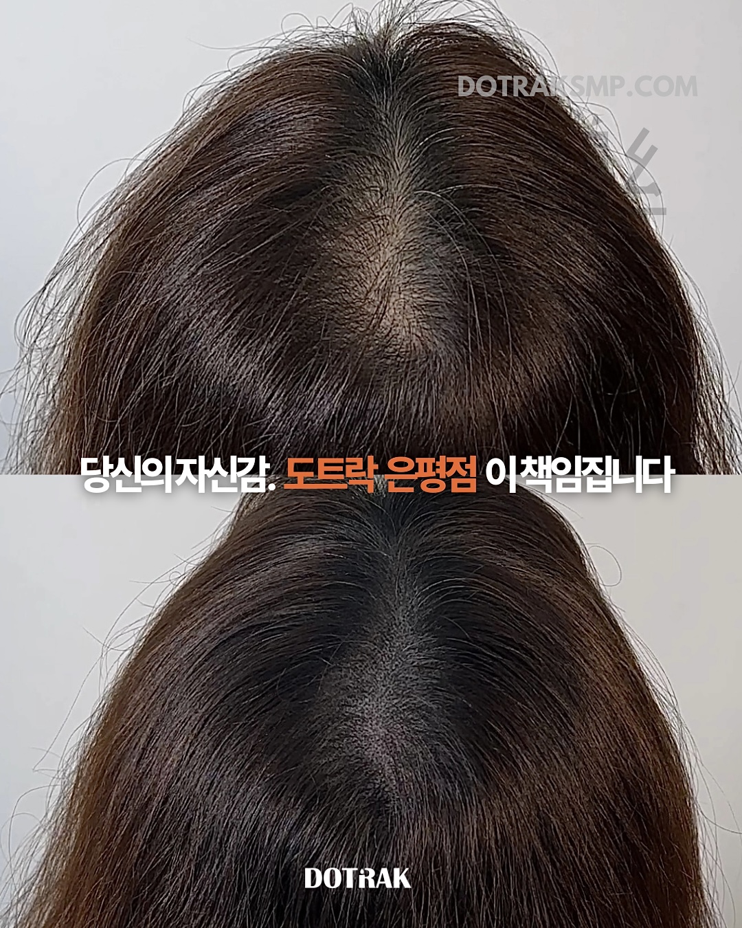도트락 은평점 시술 사례