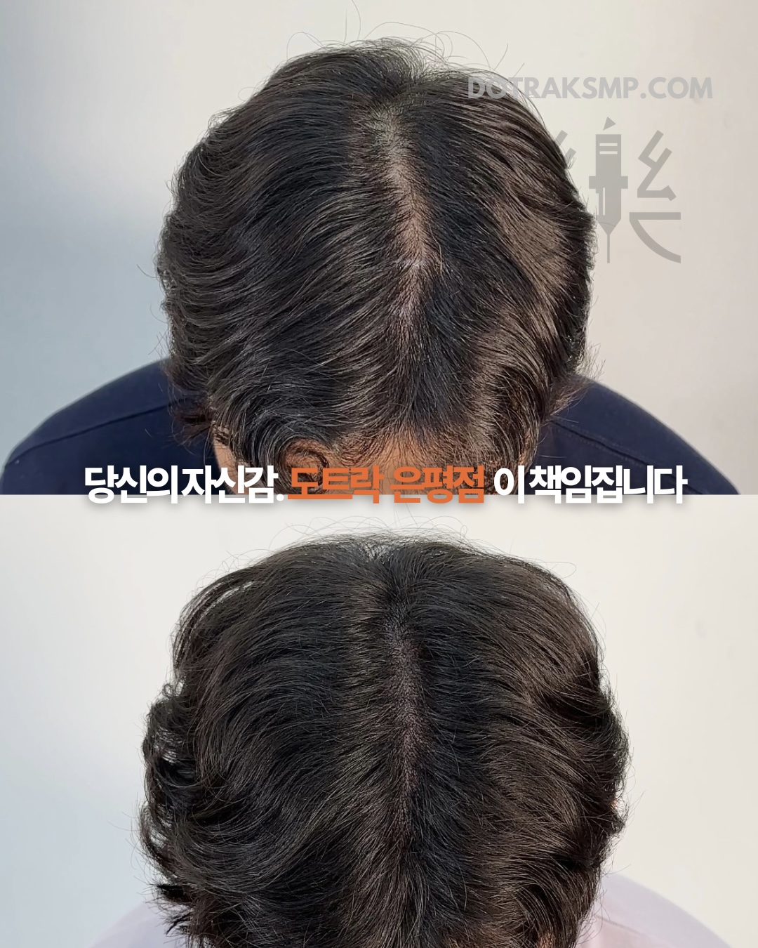 도트락 은평점 시술 이미지