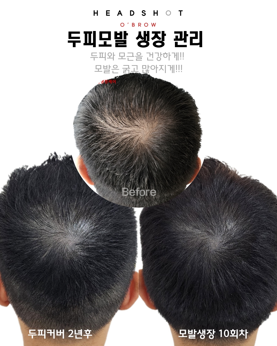 헤드샷스칼프 오브로우 대표 이미지