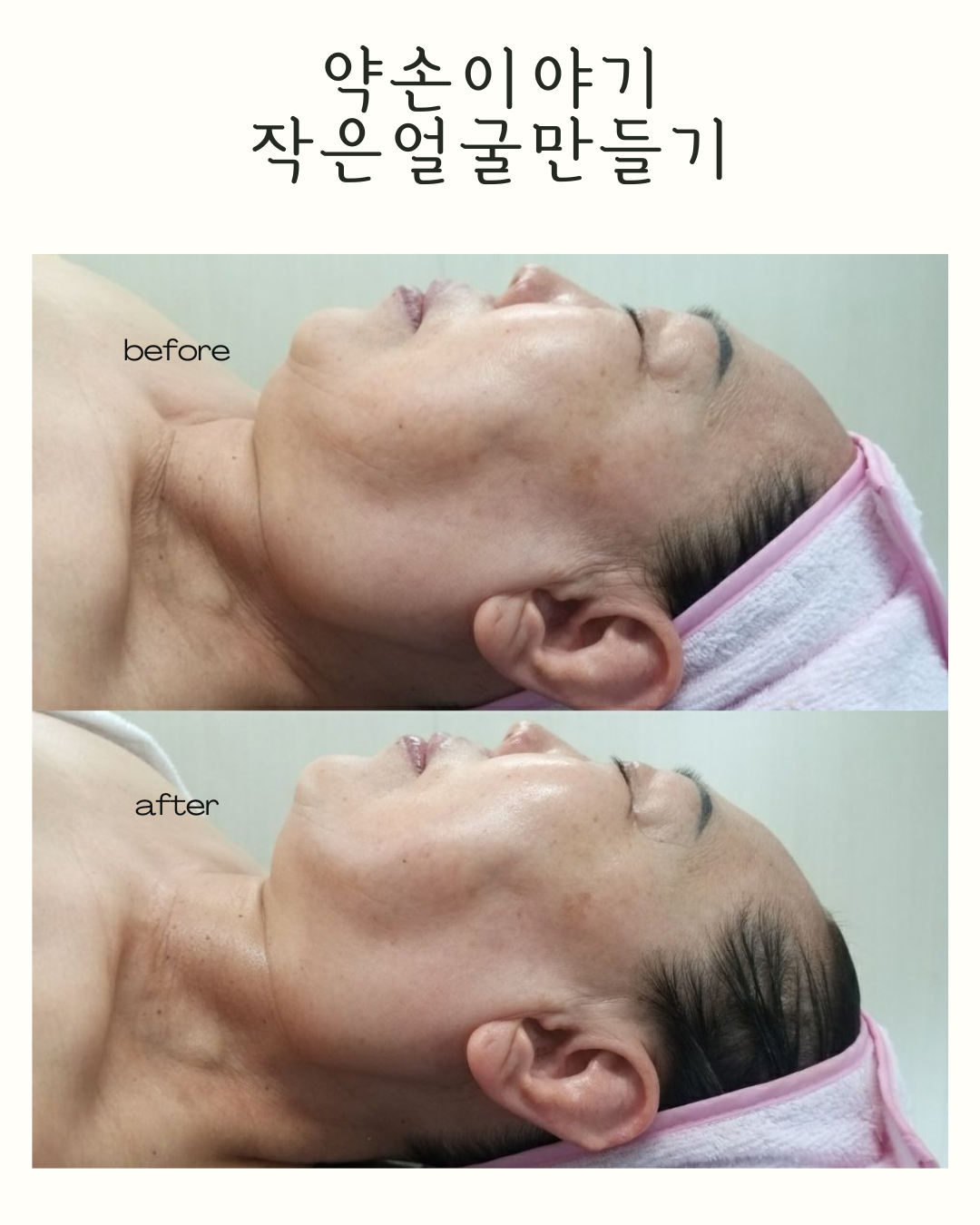 약손이야기 작은얼굴만들기 photo 7