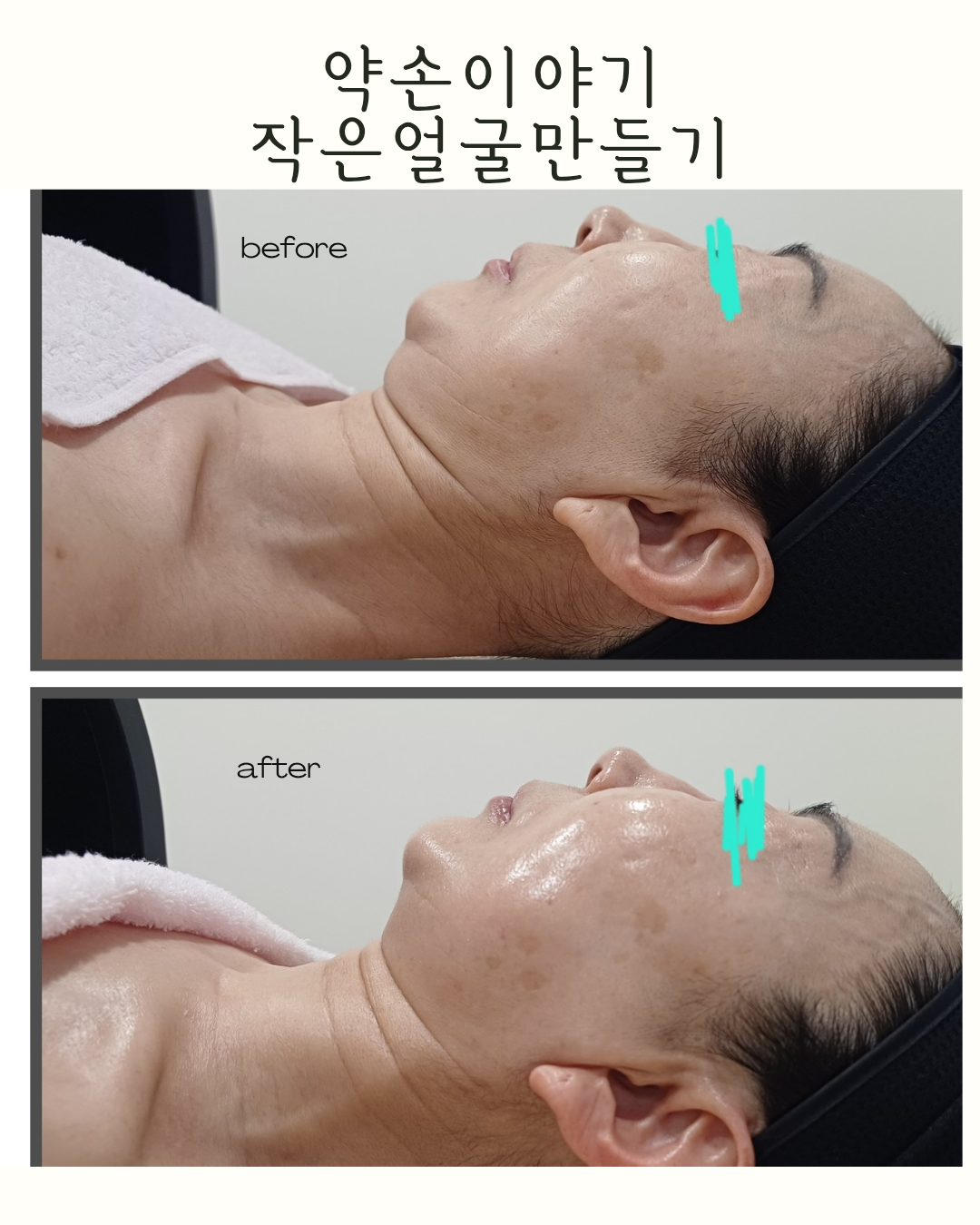 약손이야기 작은얼굴만들기 photo 10