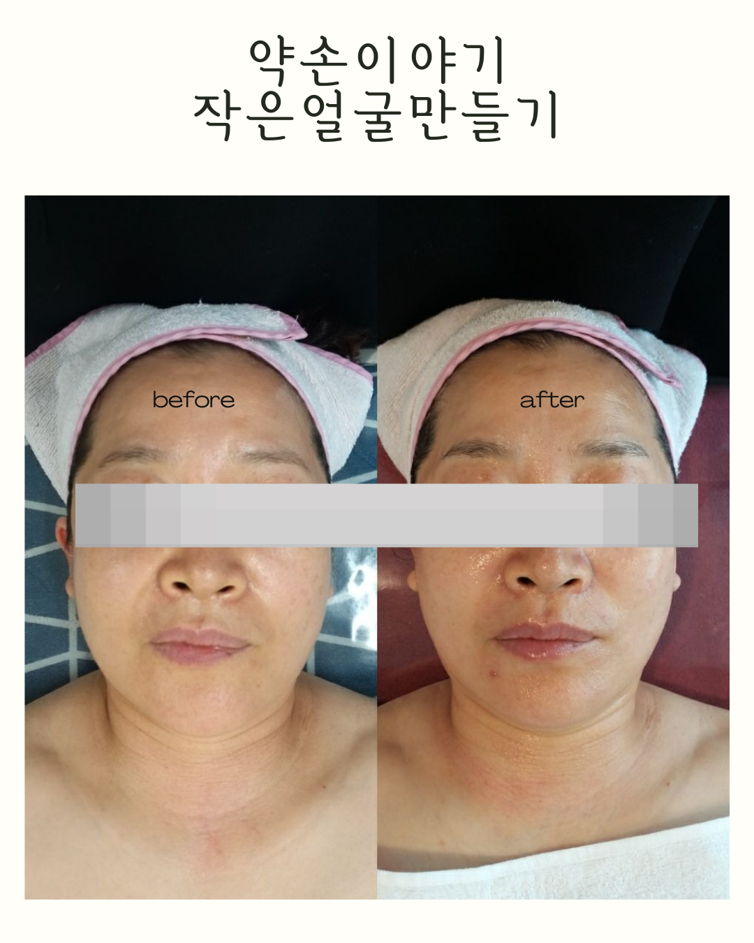약손이야기 작은얼굴만들기 photo 8