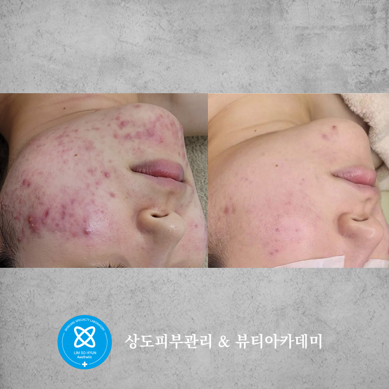 임소현 피부관리 대표 이미지