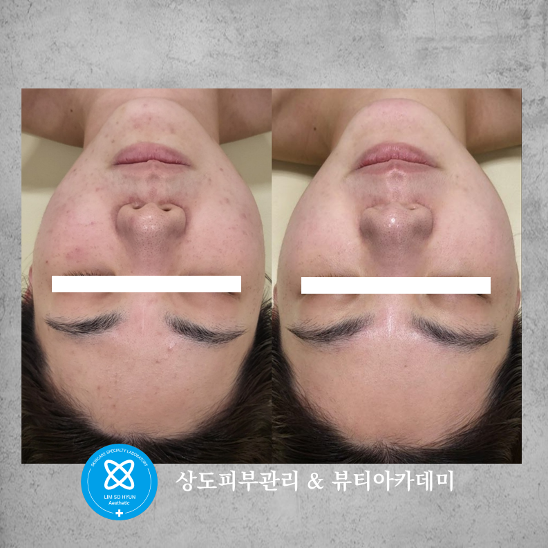 임소현 피부관리 여드름홍조&얼굴비대칭&안면윤곽 상도점 대표 이미지