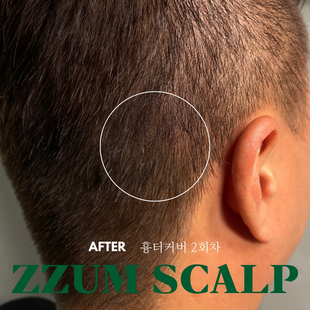 쩜스칼프 울산
