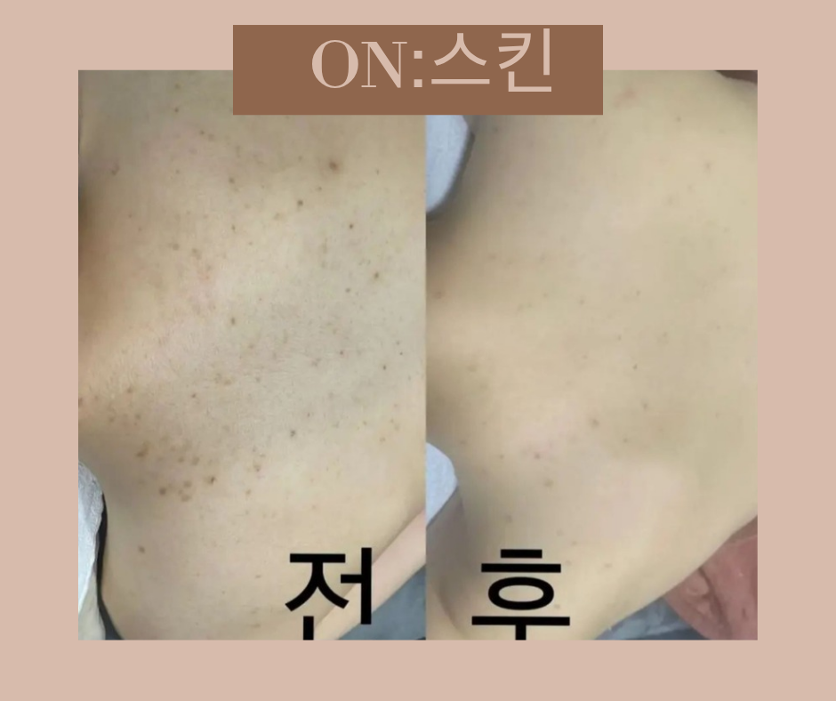 온스킨