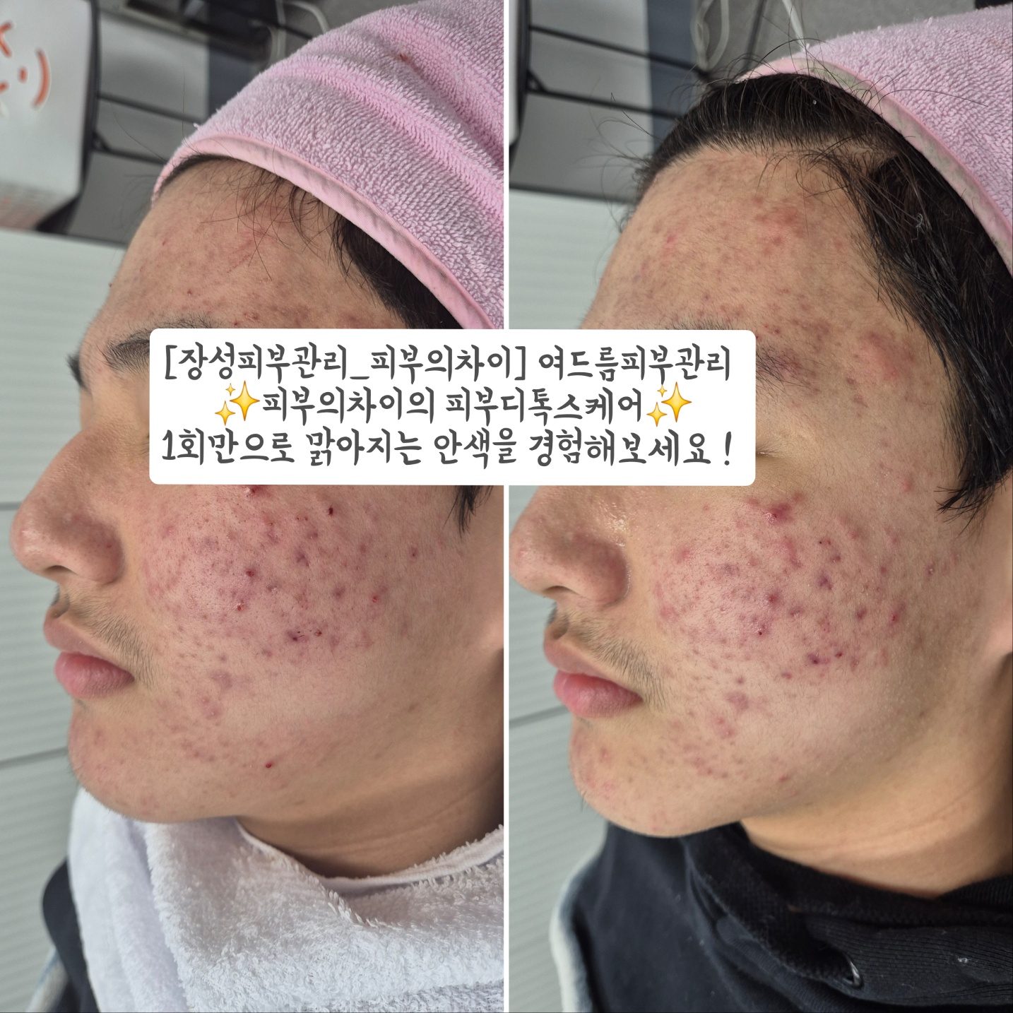 피부의차이 photo 3