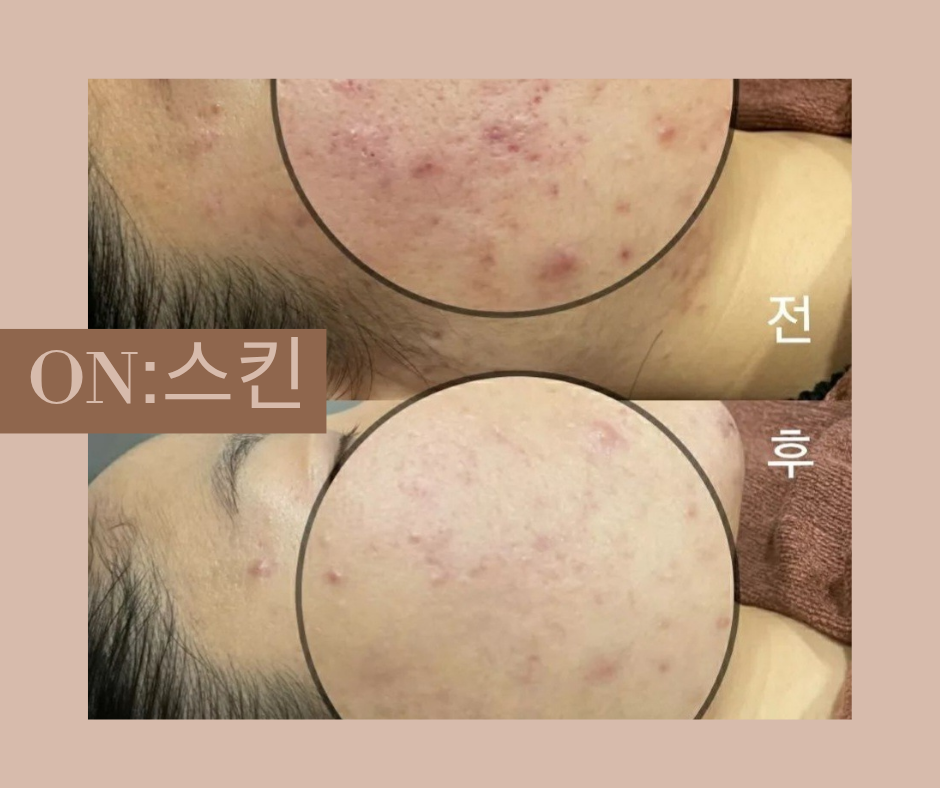 온스킨