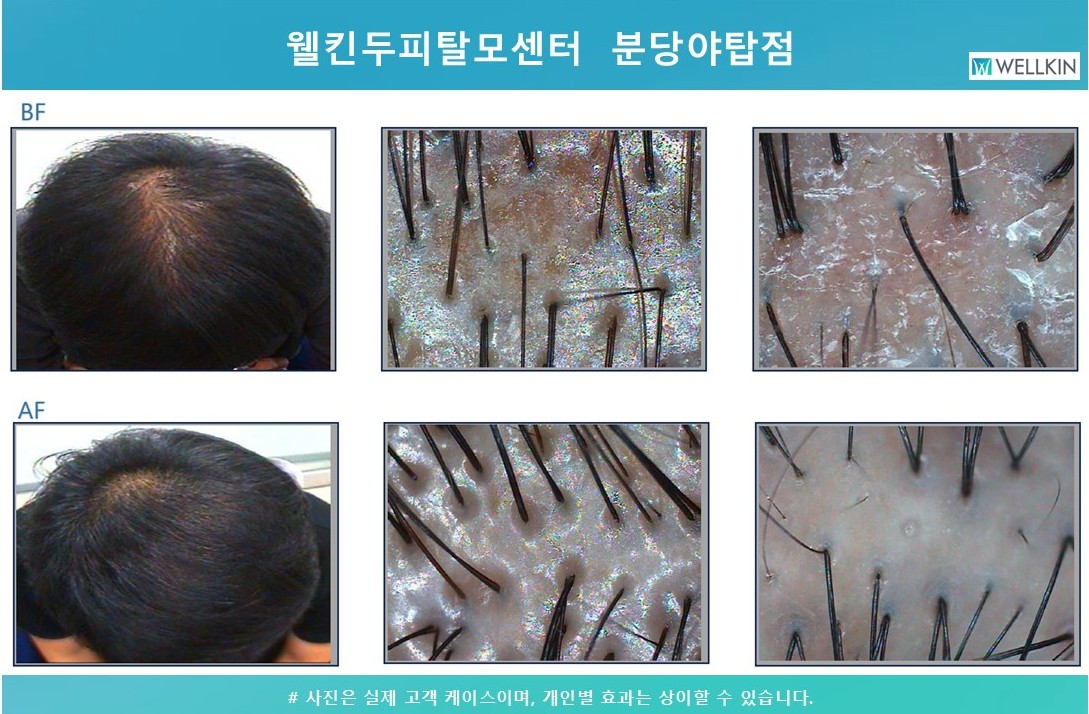 웰킨두피탈모센터 분당야탑점 대표 이미지