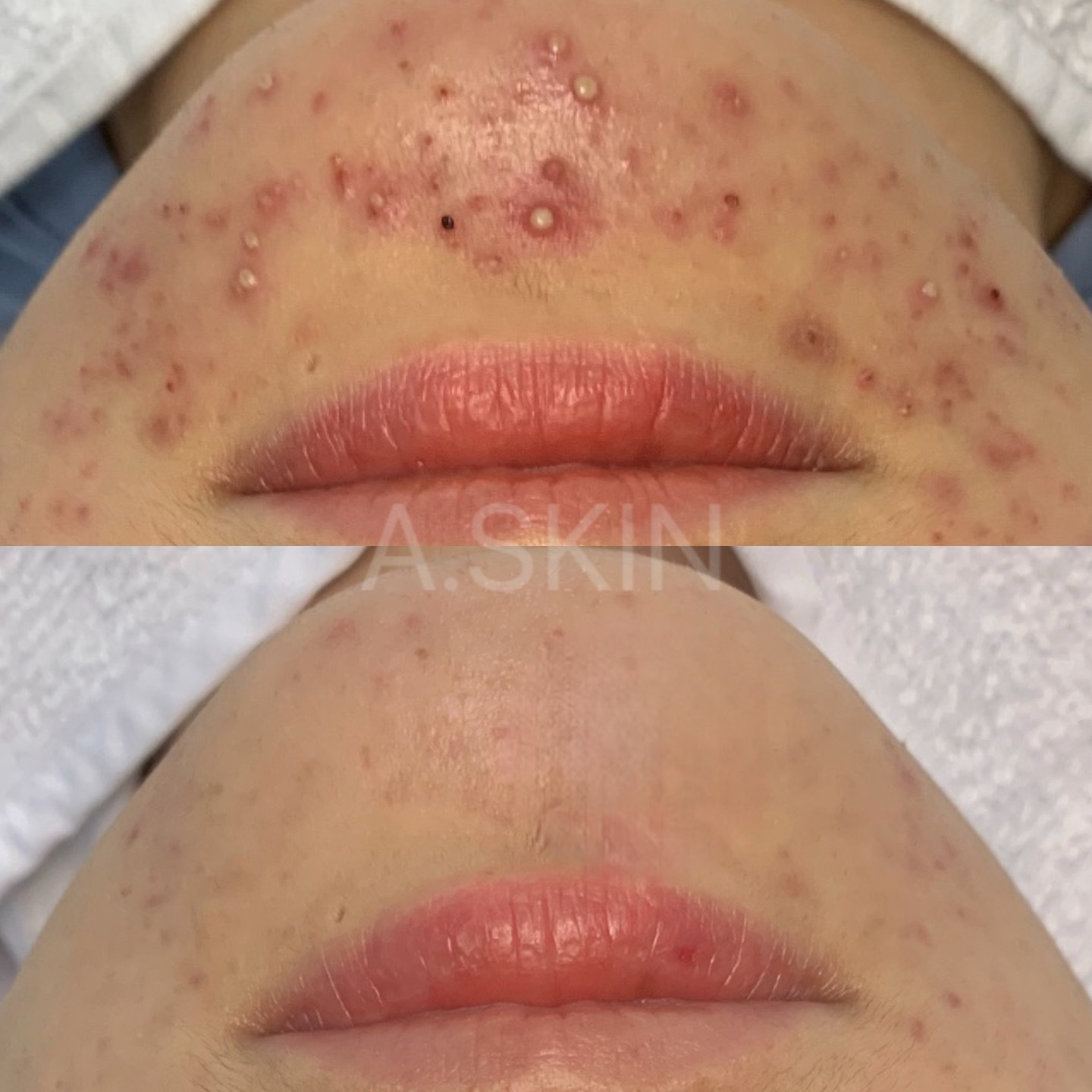 에이스킨 대표 이미지