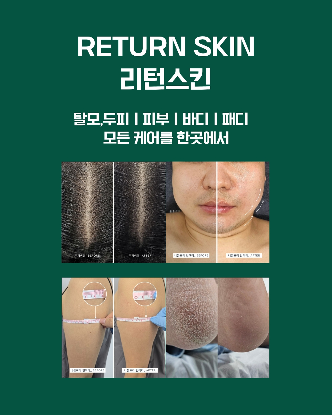 리턴스킨 대표 이미지