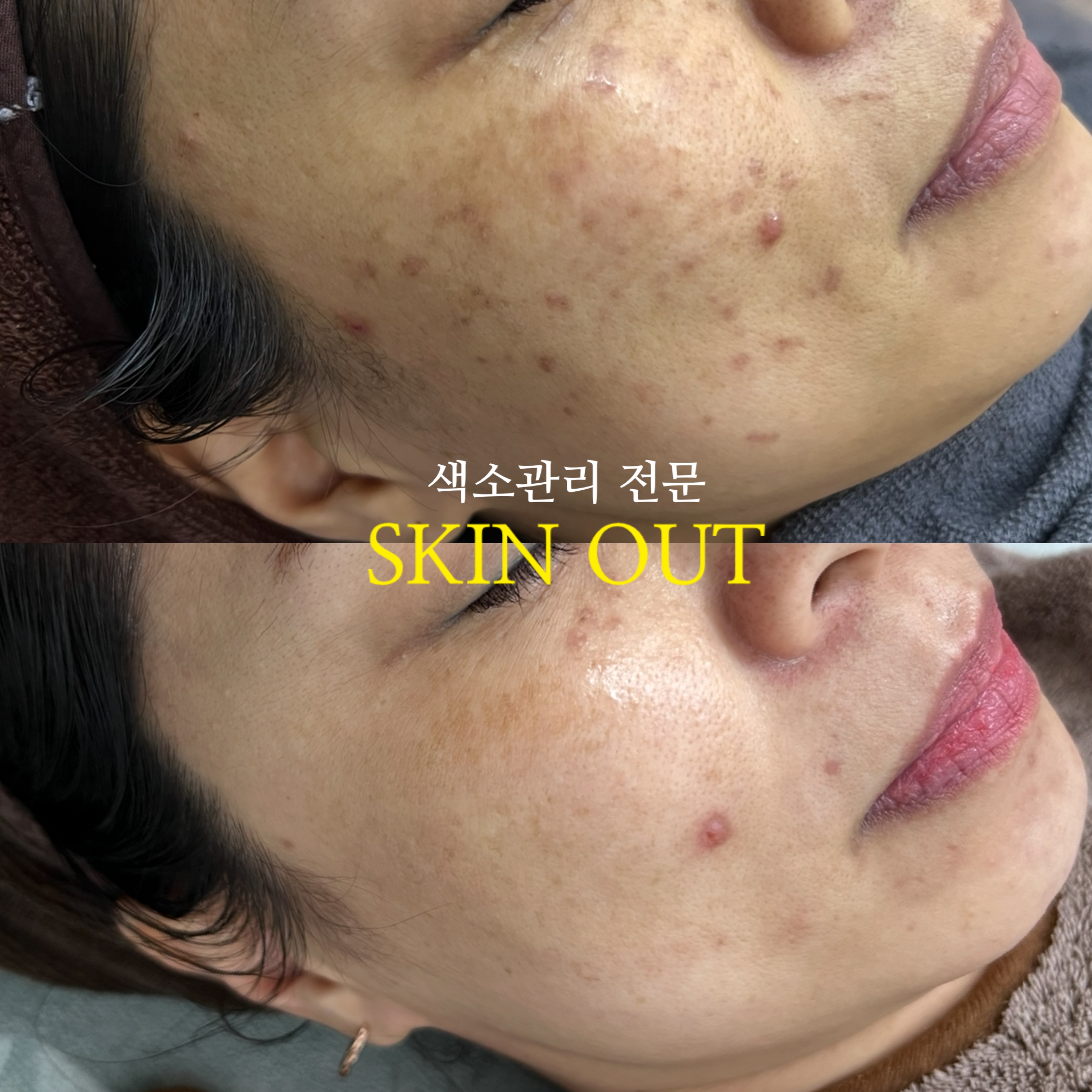 스킨아웃 대표 이미지