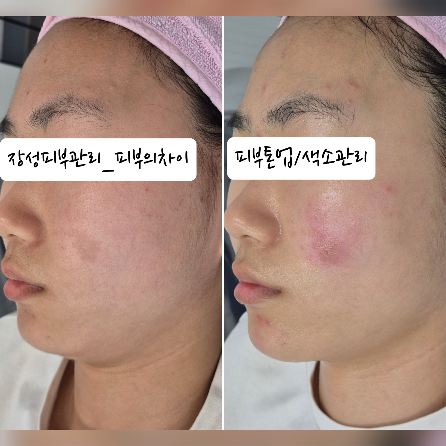 피부의차이 photo 6