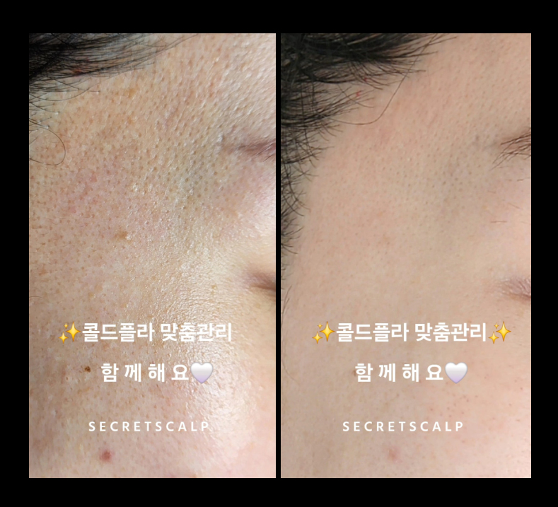 시크릿스칼프 대표 이미지