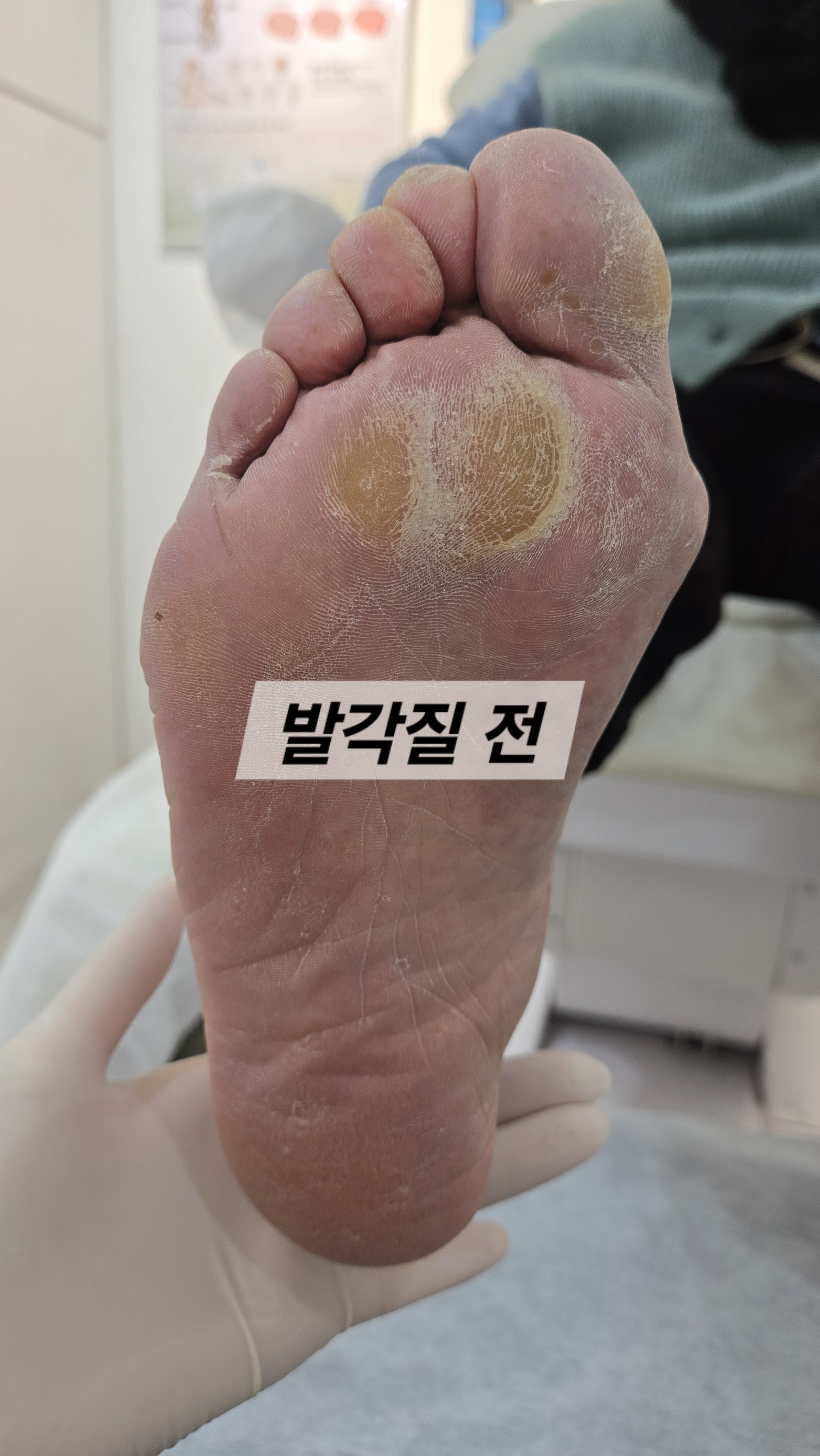 젤이쁜네일 발각질 내성무좀 대표 이미지