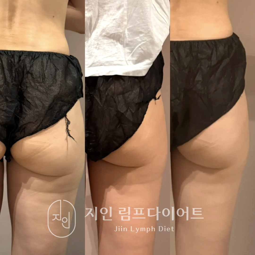지인림프다이어트 photo 9