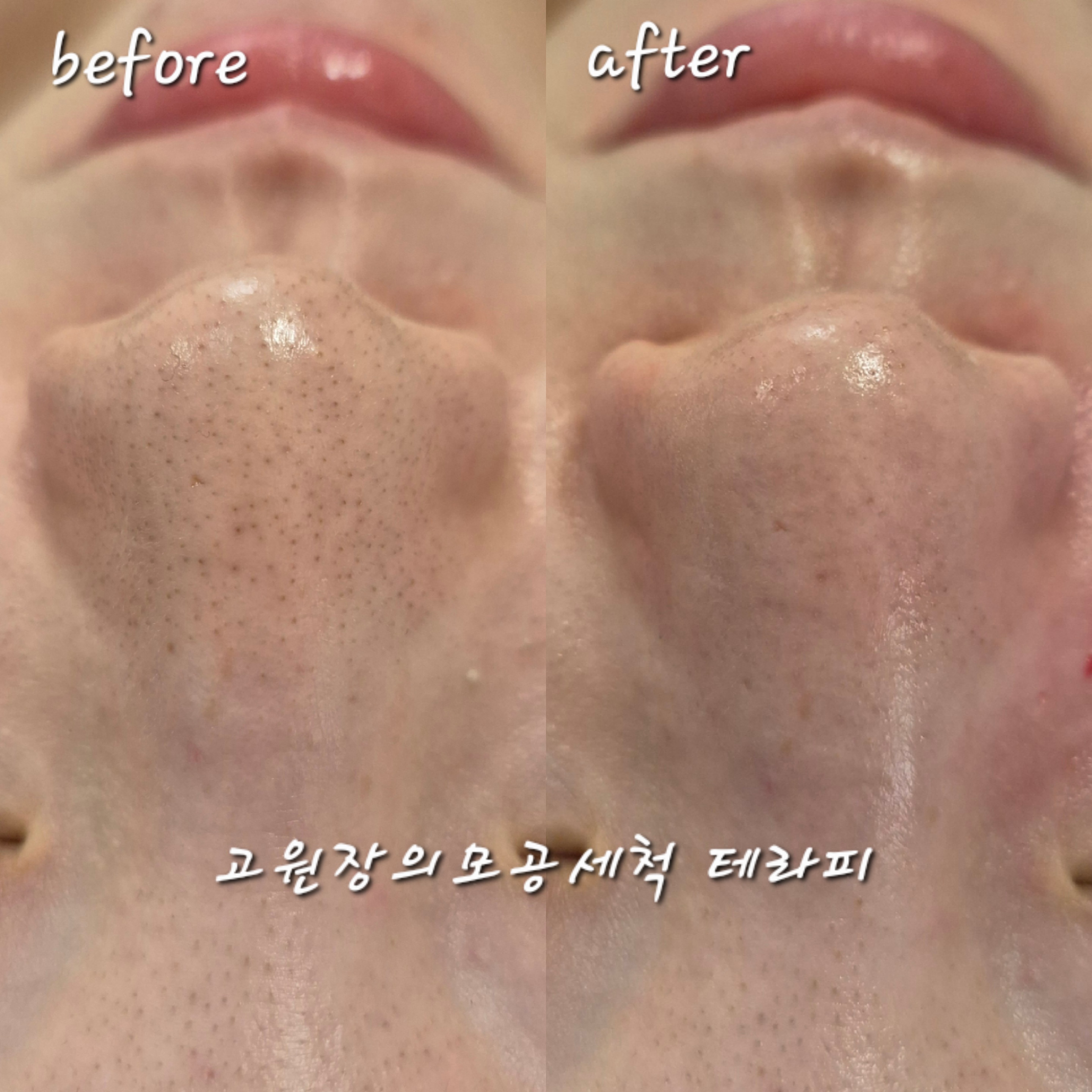 고원장의모공세척테라피 대표 이미지