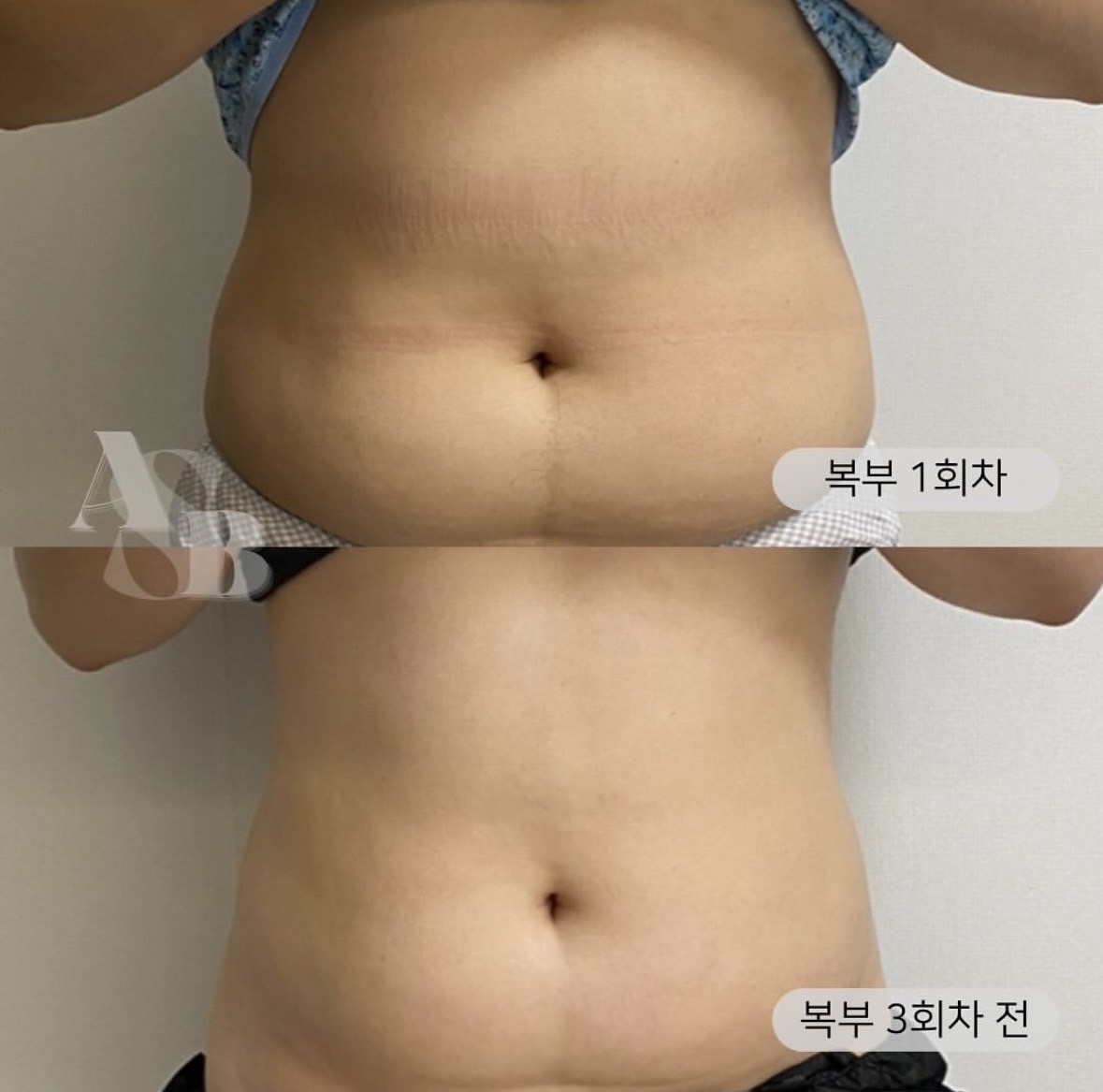 디에이치뷰티 에어바디&두피리프팅 photo 5