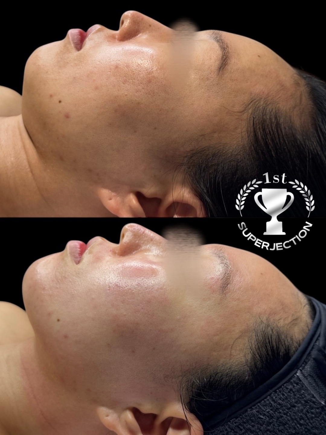 스킨챕터 대표 이미지